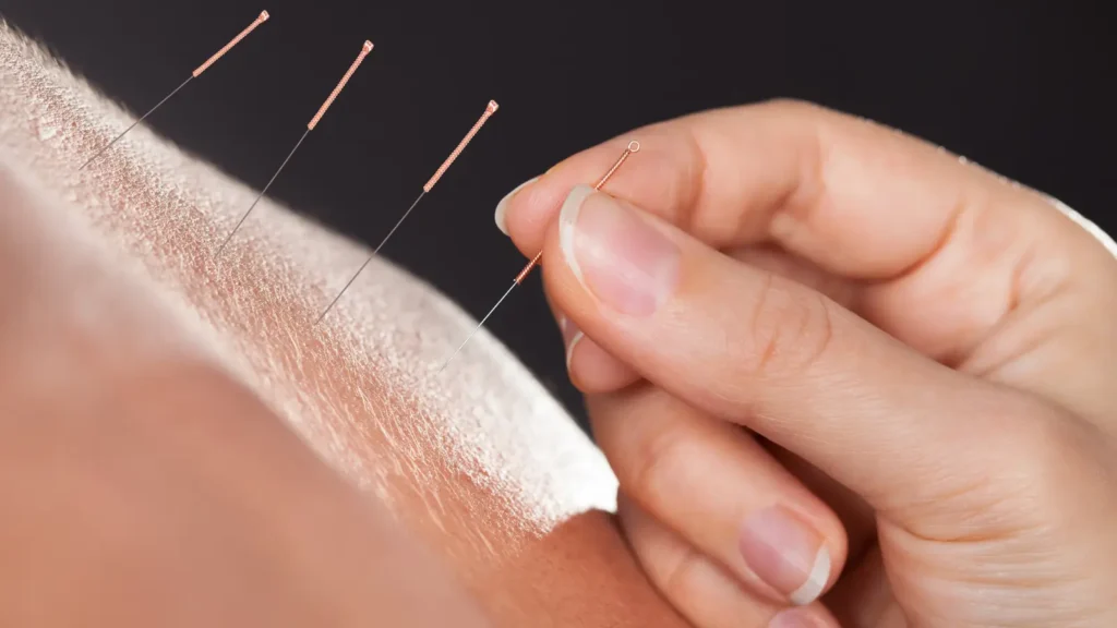 Akupunktura jak działa i na co pomaga